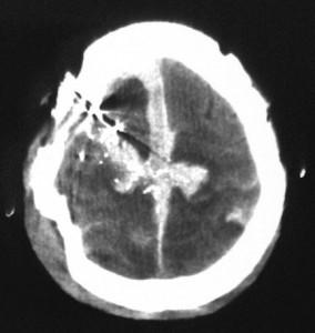 A 65-year-old man experienced a gunshot wound to the right frontoparietal region. A CT scan shows that the bullet crossed the midline, lacerated the superior longitudinal sinus, and produced a large midline subdural hematoma. The patient presented with a Glasgow Coma Scale (GCS) score of 4 and died.